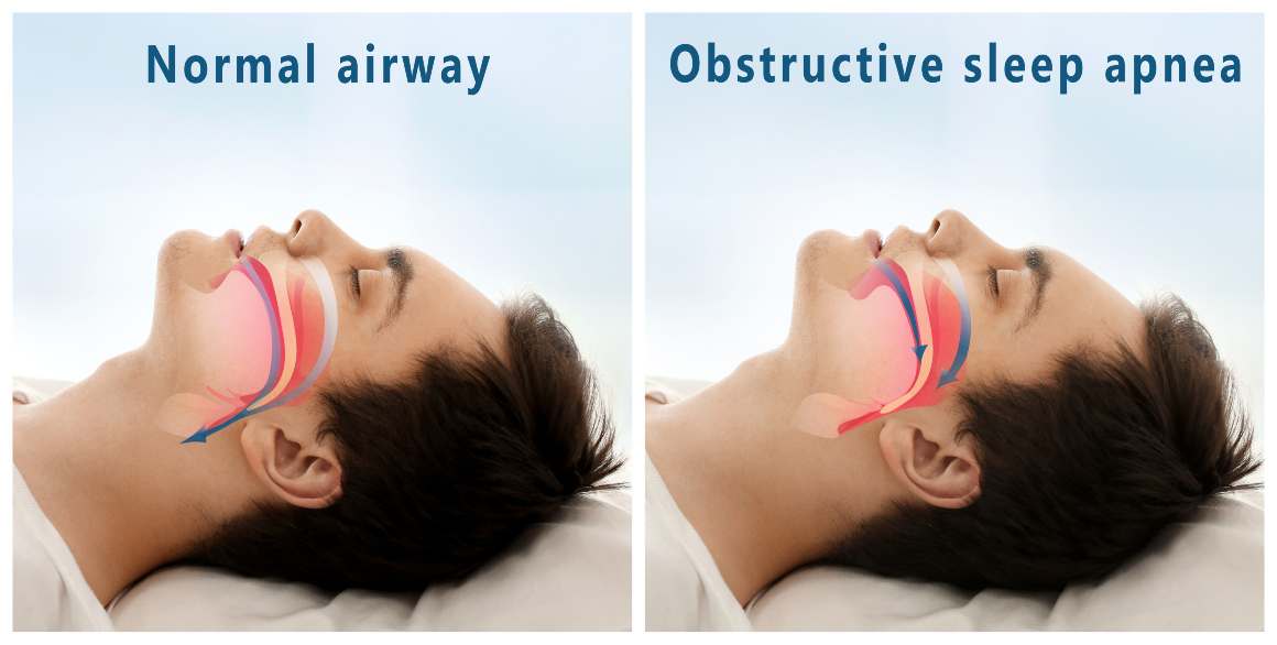 Options de traitement de l'apnée obstructive du sommeil