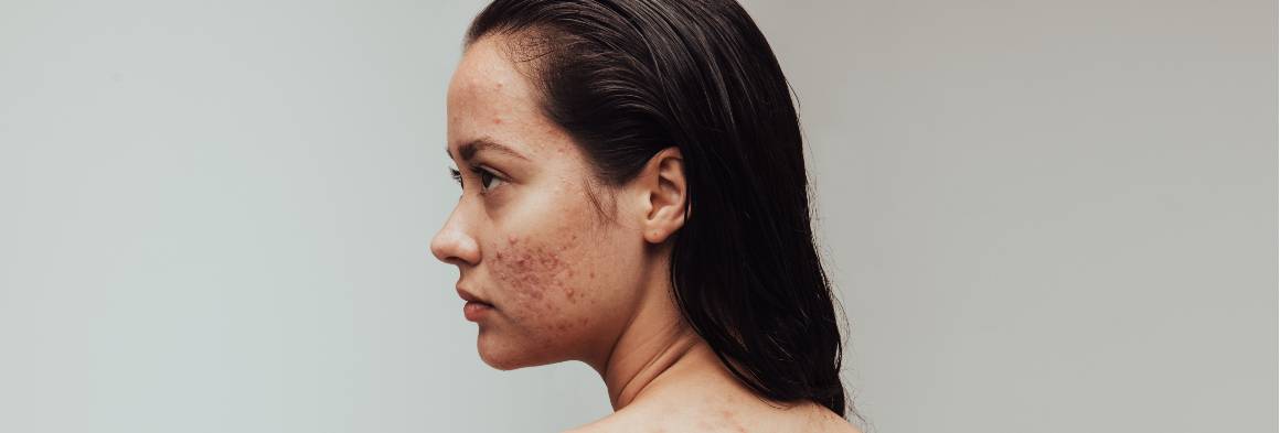 Mon acné peut-elle disparaître naturellement ?