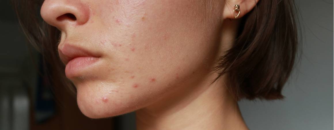 L'acné est-elle synonyme de faiblesse du système immunitaire ?