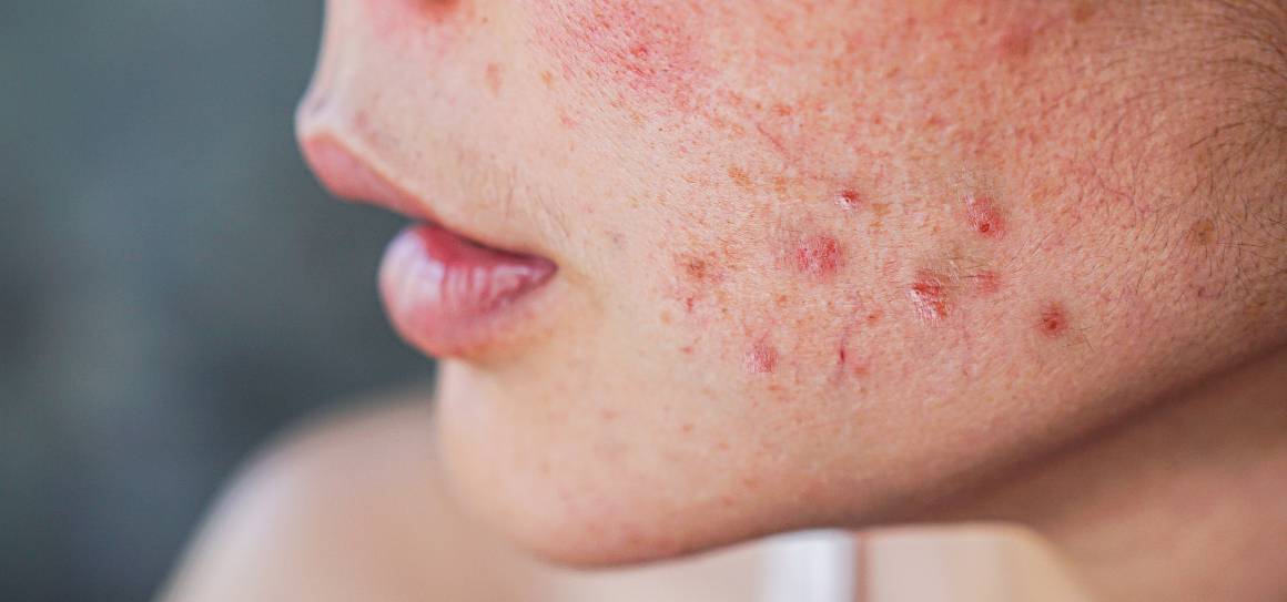 Comment les dermatologues se débarrassent-ils de l'acné ?