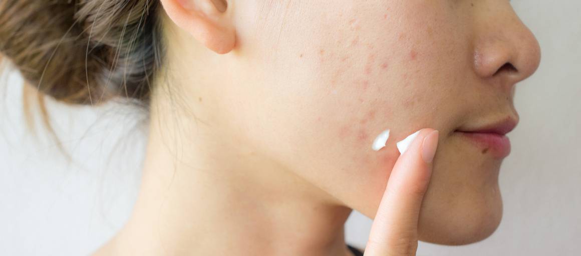 Comment prévenir l'acné naturellement ?