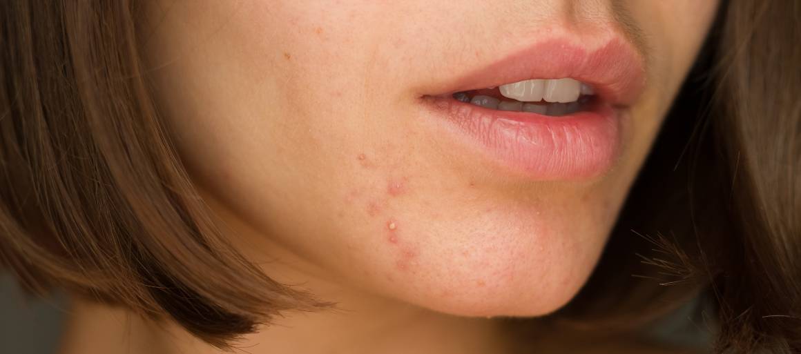 Quels sont les aliments qui aident à traiter l'acné ?
