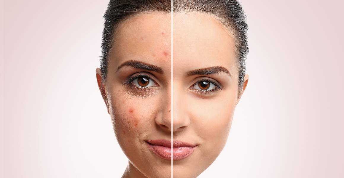 Quelle est la cause principale de l'acné ?