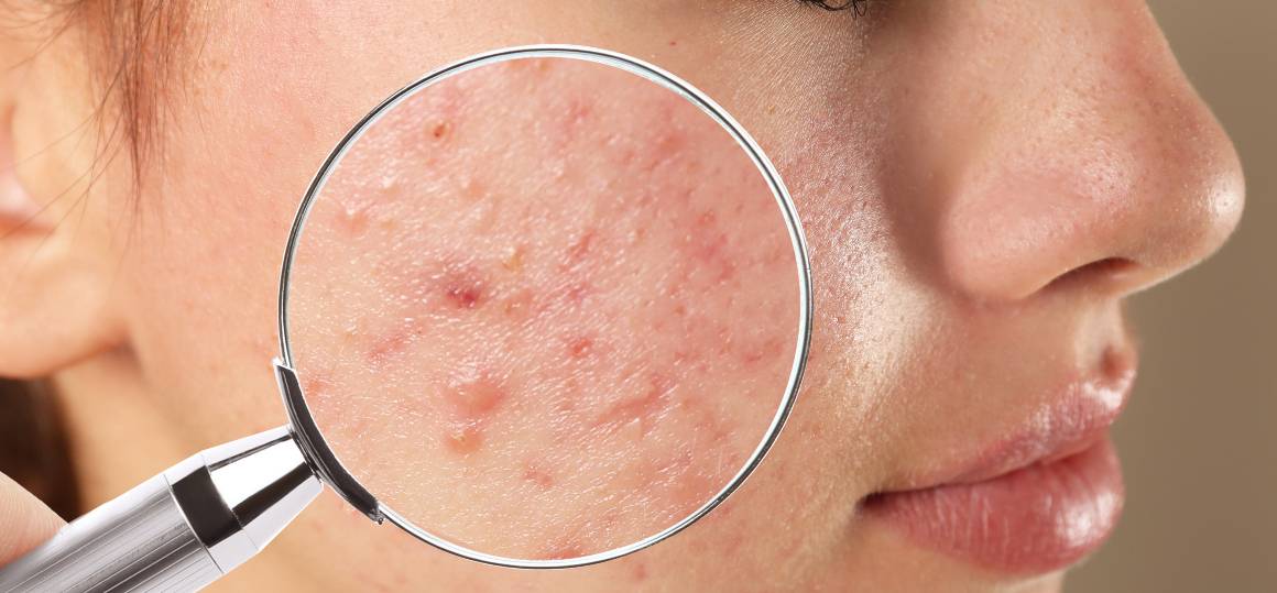Pourquoi est-il si difficile de se débarrasser de l'acné ?