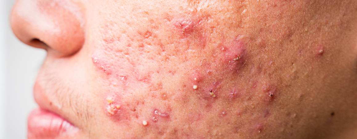 L'acné disparaît-elle d'elle-même ?