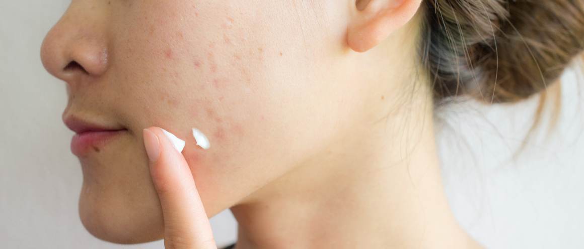 Pimple popping » : Percer son bouton, si, si, on peut le faire