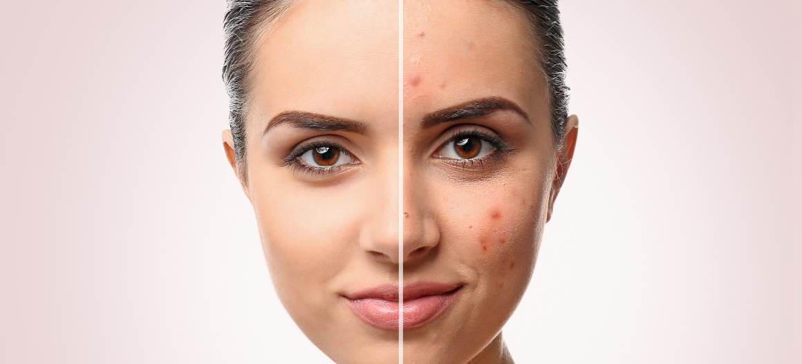 Quels sont les 4 types d'acné ?