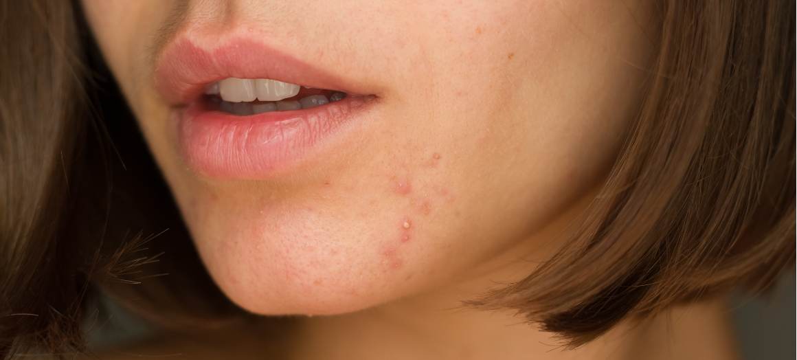 Quelles sont les causes de l'acné sur le menton ?