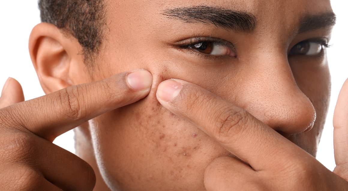 Quels sont les deux types d'acné les plus courants ?