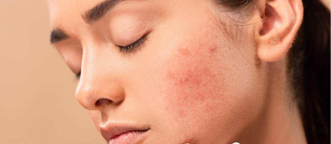 Quel type d'acné est le plus difficile à traiter ?