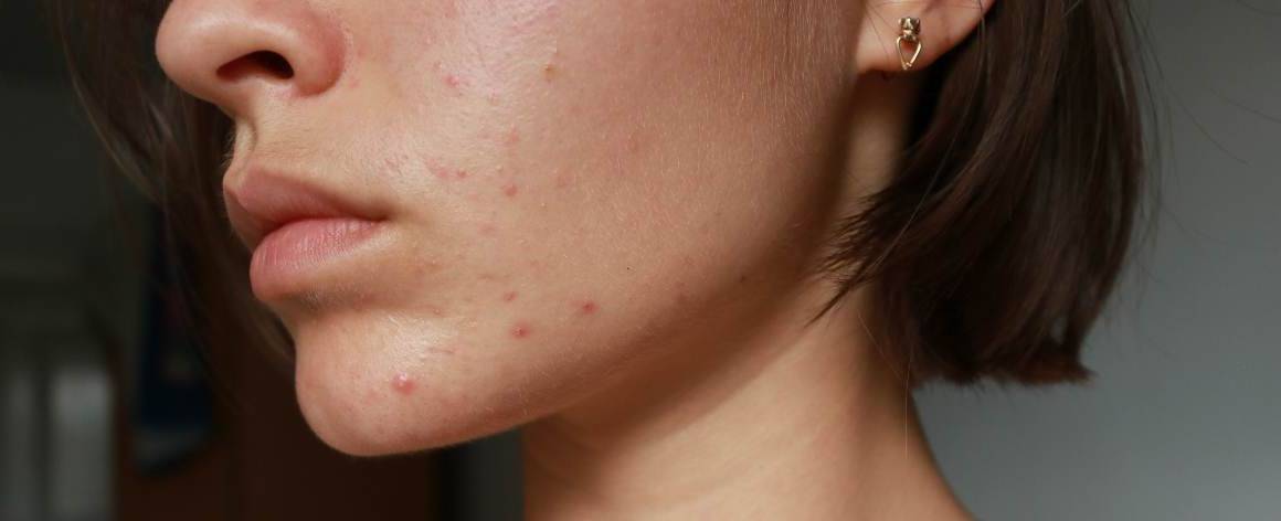 Comment savoir si mon acné est d'origine hormonale ou due au stress ?