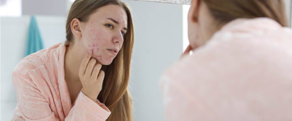 Les 10 meilleurs fruits qui aident à éliminer l'acné