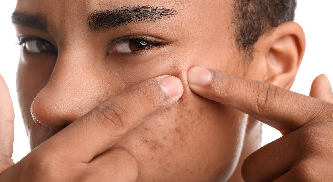 Qu'est-ce qui déclenche l'acné kystique ?
