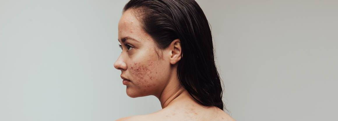 La déshydratation peut-elle provoquer l'acné ?