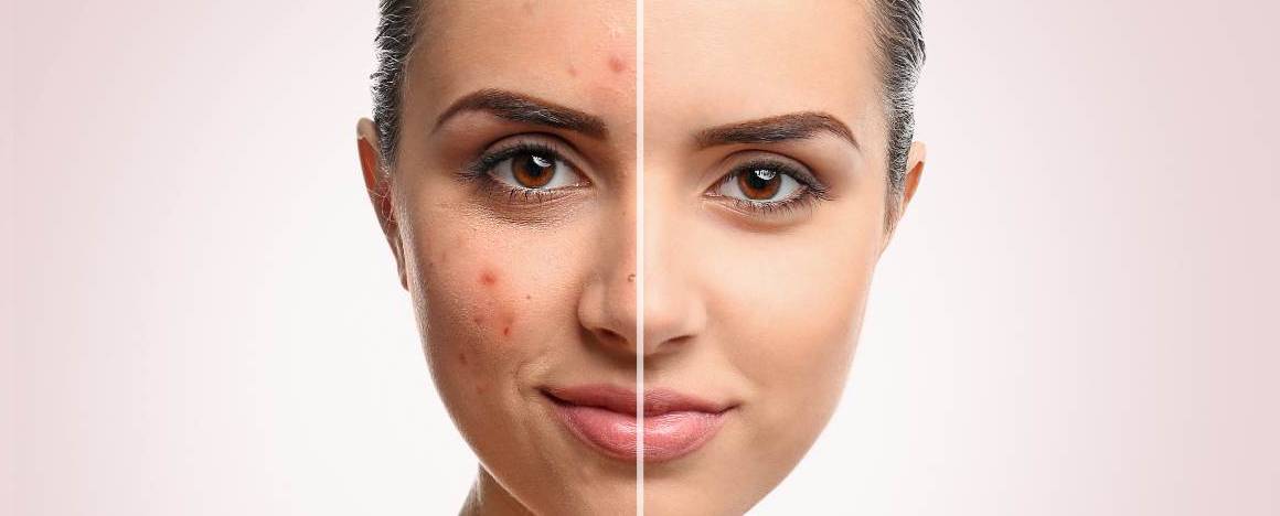 Le fait de se laver le visage aggrave-t-il l'acné ?