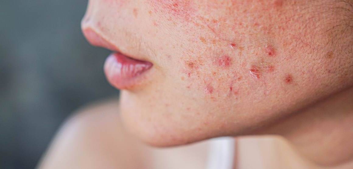 L'acné est-elle synonyme de vieillissement plus lent ?