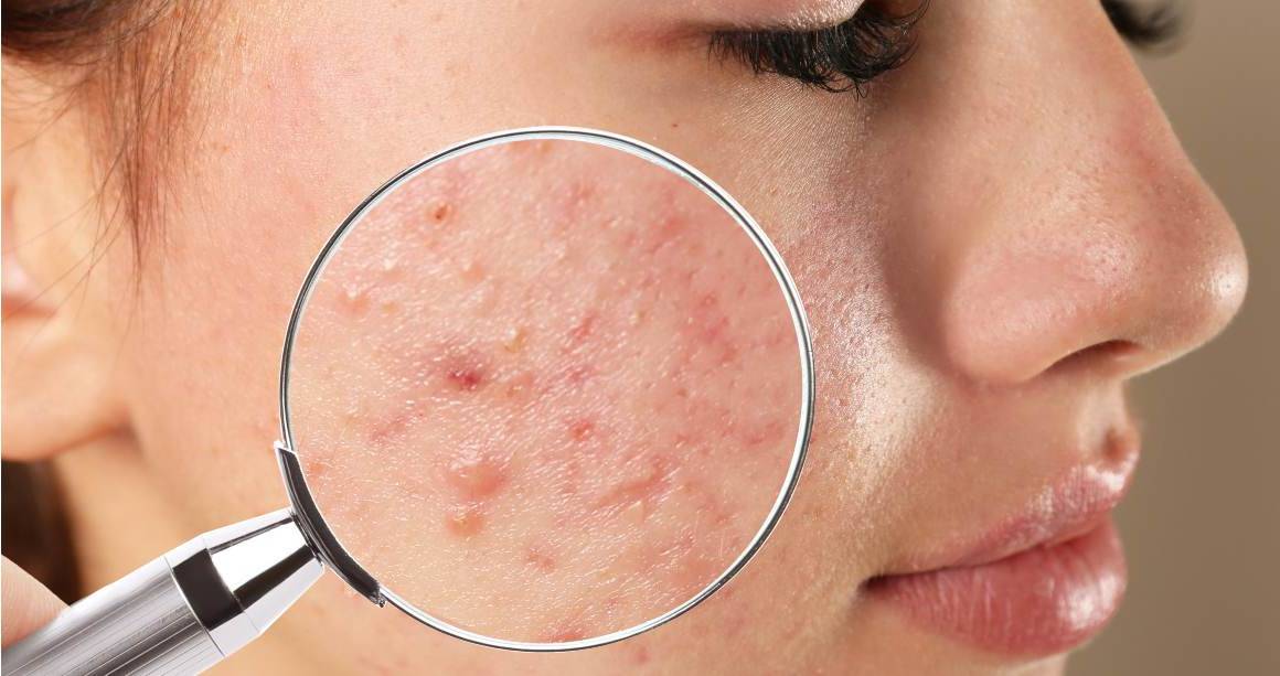 Combien de temps faut-il pour faire disparaître complètement l'acné ?