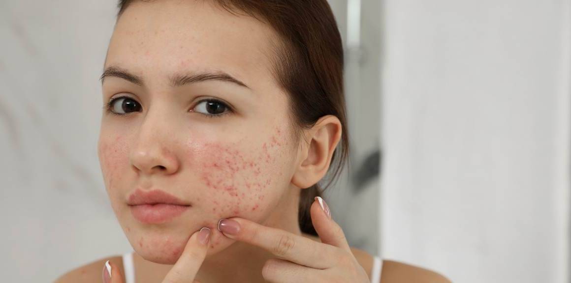 Les bienfaits surprenants de l'acné