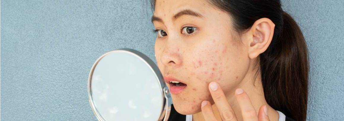 À quel âge l'acné est-elle la plus grave ?