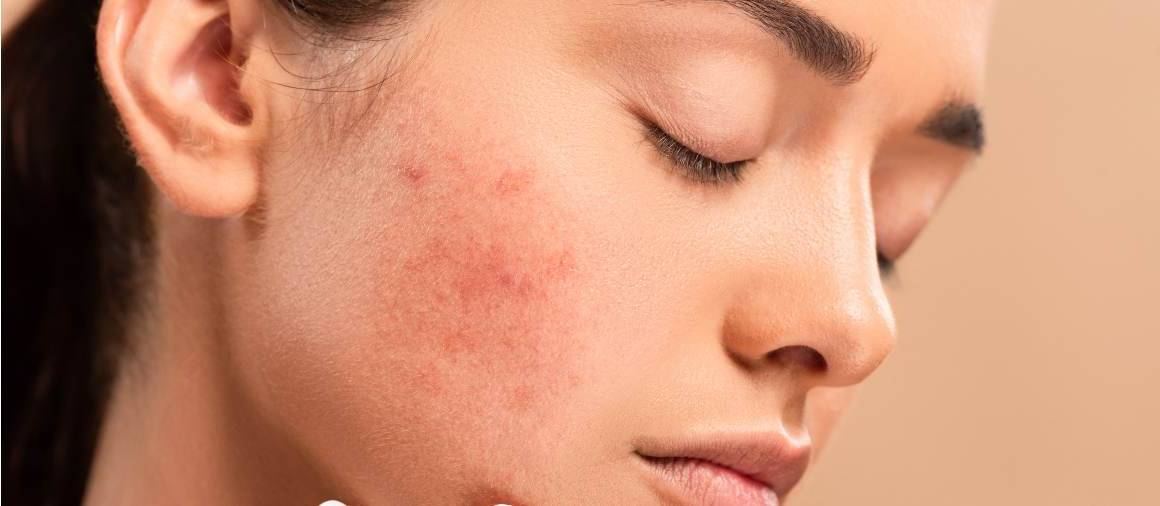 Que prescrivent généralement les dermatologues en cas d'acné ?
