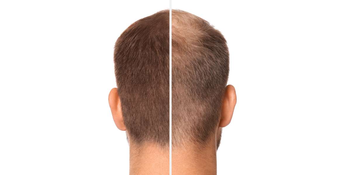 Les oméga-3 favorisent-ils la croissance des cheveux ?