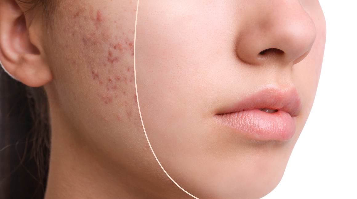 Quelles sont les 5 causes de l'acné ?