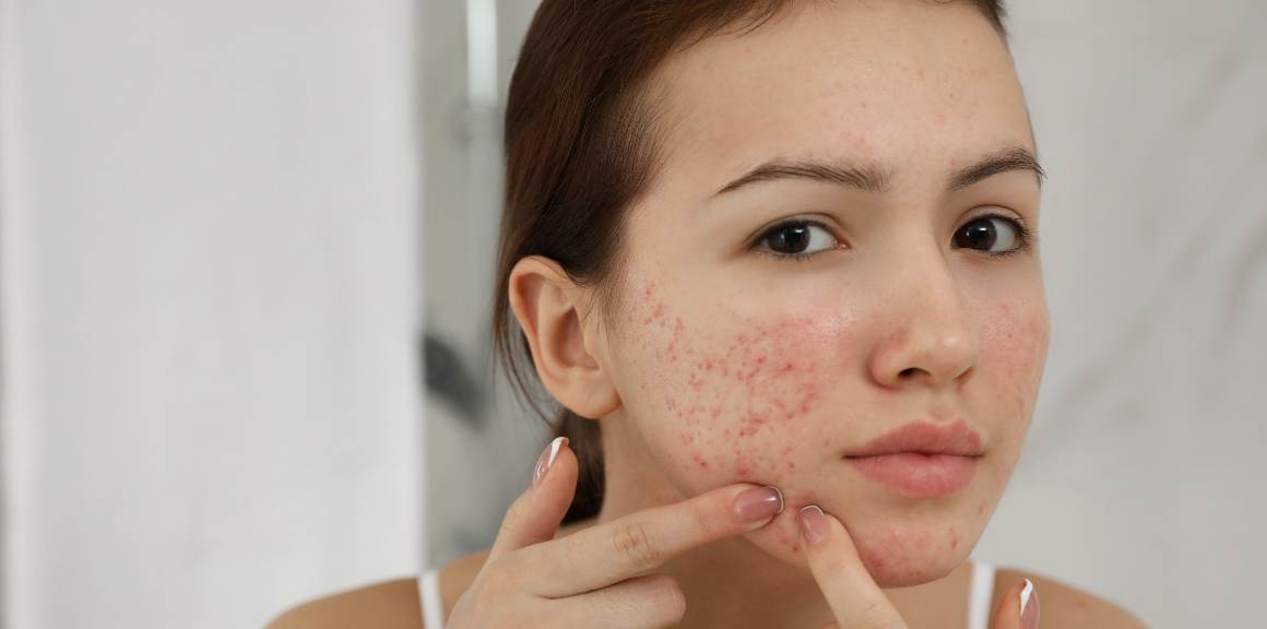 Quelle est l'hormone responsable de l'acné chez les femmes ?