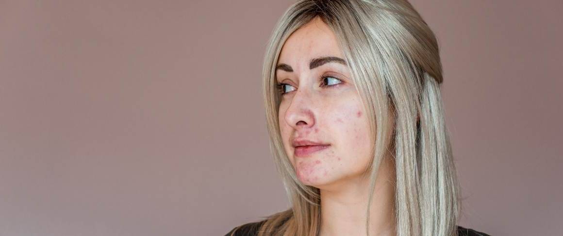 Que signifie l'acné sur les joues ?