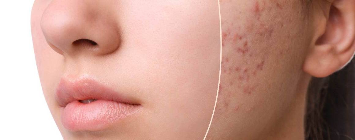 Le manque de sommeil provoque-t-il l'acné ?